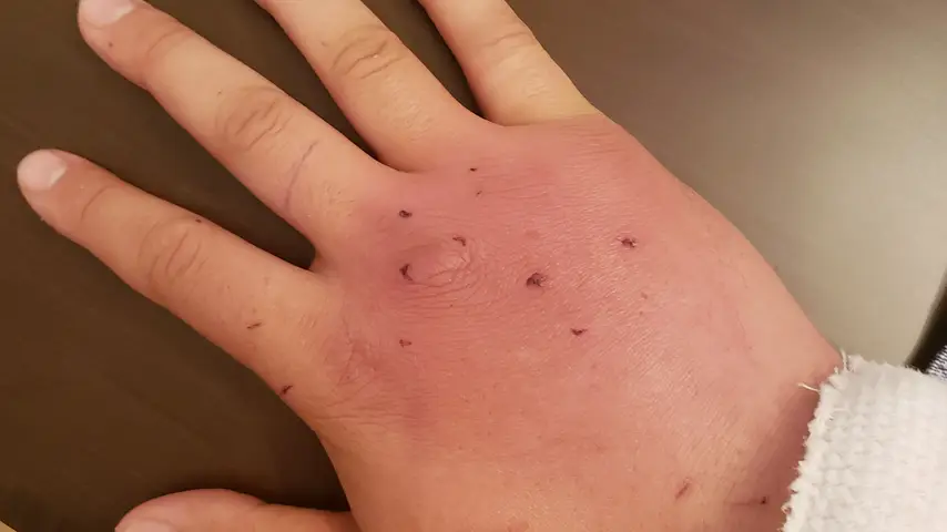 Swelling